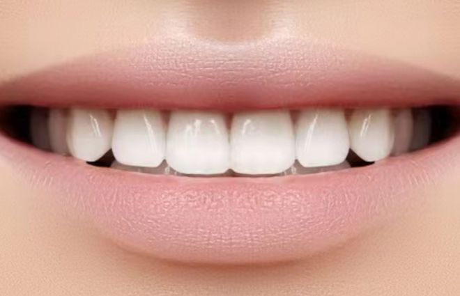 牙齿美容过来人的真实分享免磨牙贴面更健康